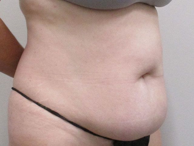Abdominoplasty Before & After
