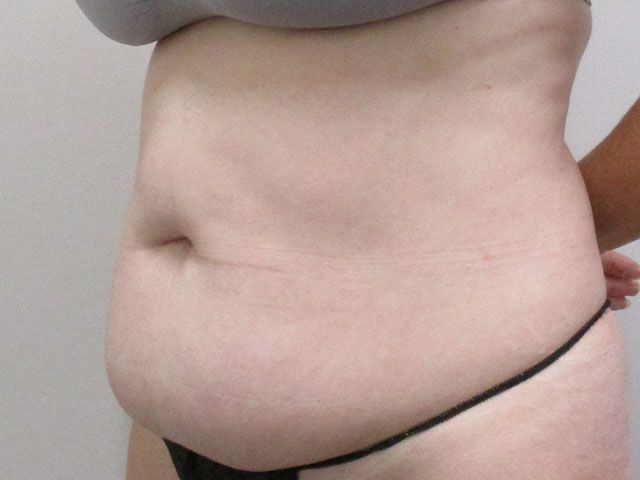Abdominoplasty Before & After