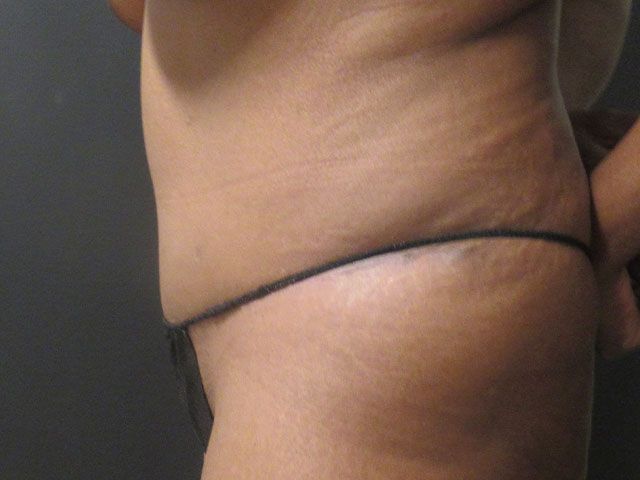 Abdominoplasty Before & After