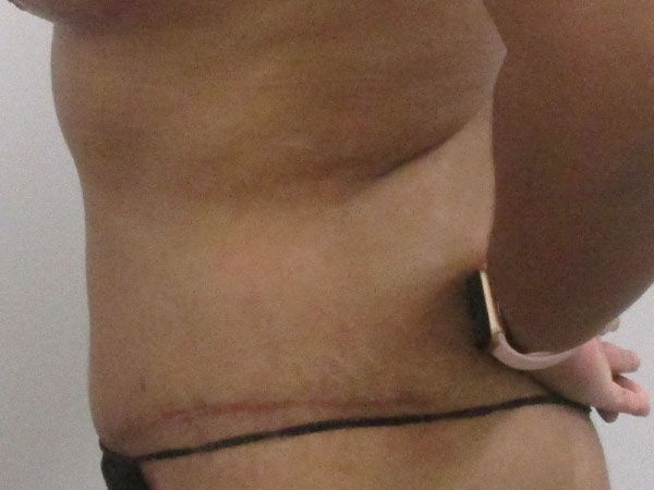 Abdominoplasty Before & After