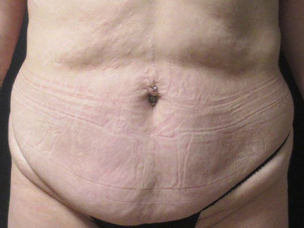 Abdominoplasty Before & After