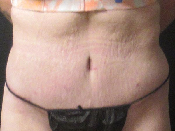 Abdominoplasty Before & After