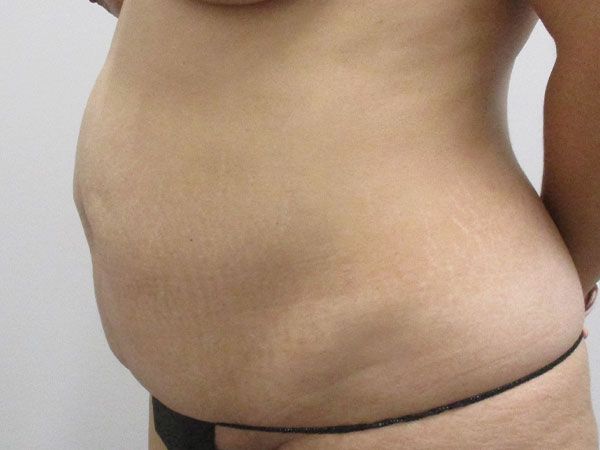 Abdominoplasty Before & After
