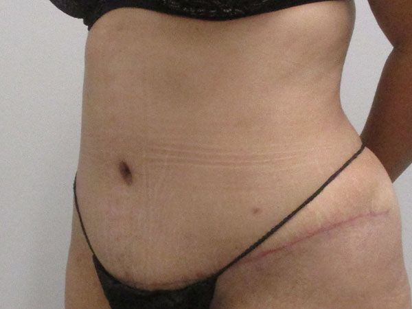 Abdominoplasty Before & After