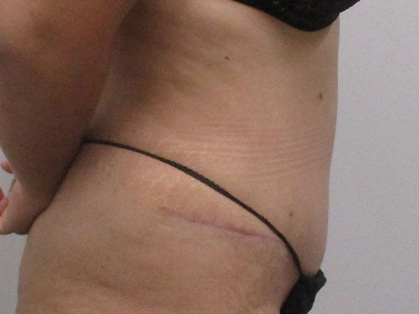 Abdominoplasty Before & After