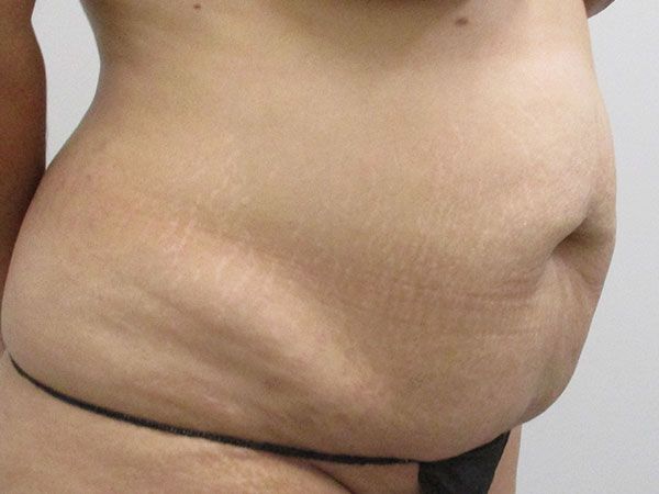 Abdominoplasty Before & After