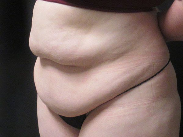 Abdominoplasty Before & After
