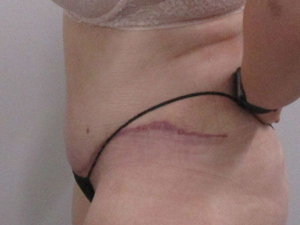 Abdominoplasty Before & After