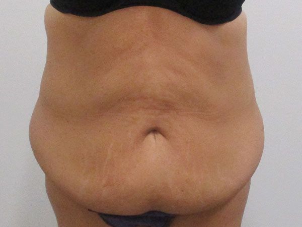 Abdominoplasty Before & After