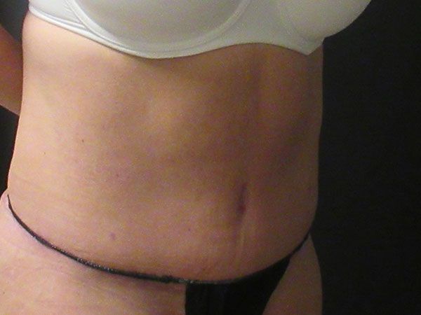 Abdominoplasty Before & After