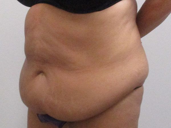 Abdominoplasty Before & After