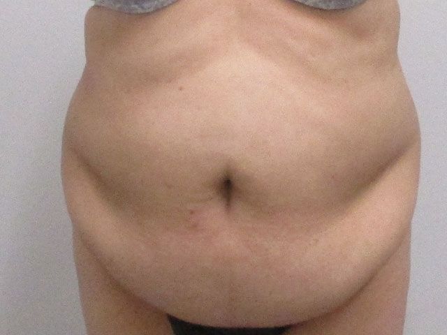 Abdominoplasty Before & After