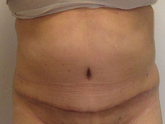 Abdominoplasty Before & After