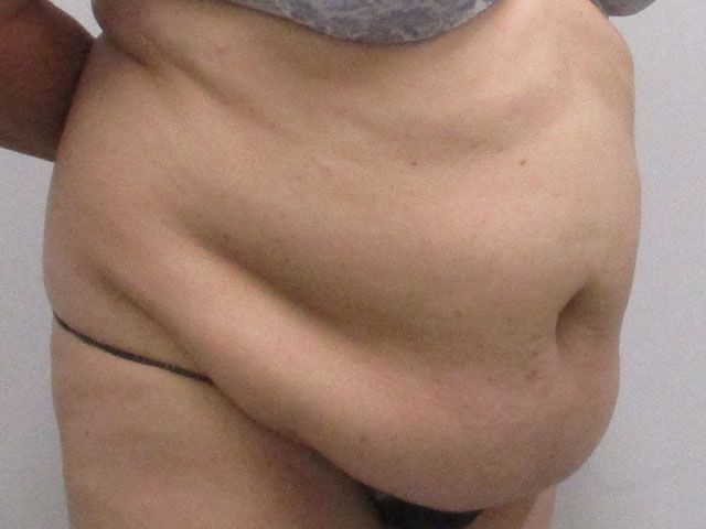 Abdominoplasty Before & After