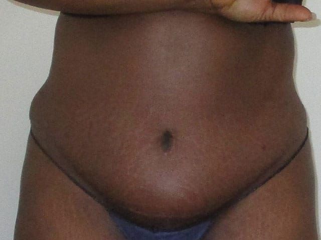 Abdominoplasty Before & After