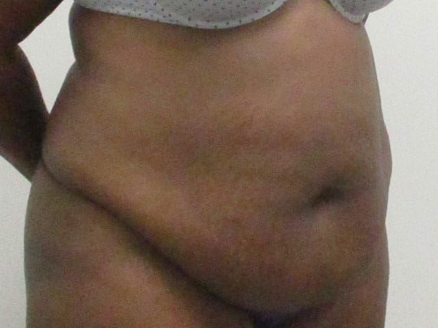 Abdominoplasty Before & After