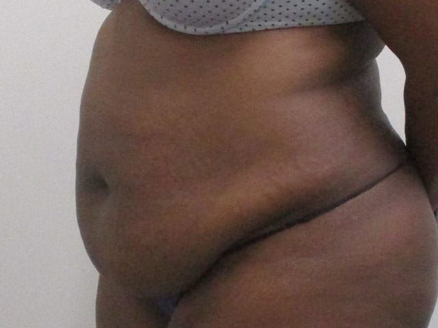 Abdominoplasty Before & After