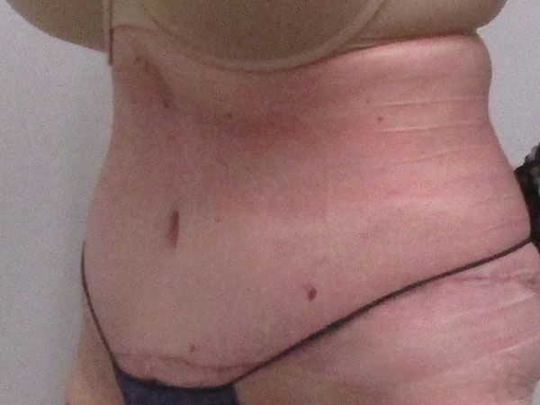 Abdominoplasty Before & After