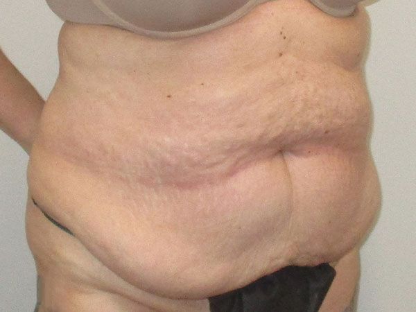 Abdominoplasty Before & After
