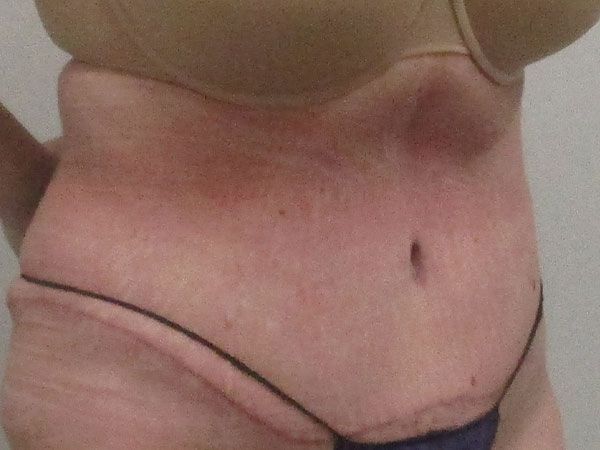 Abdominoplasty Before & After