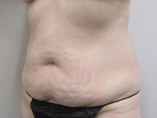 Abdominoplasty Before & After