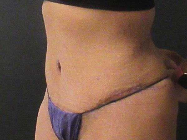 Abdominoplasty Before & After