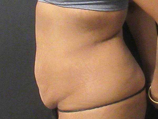 Abdominoplasty Before & After