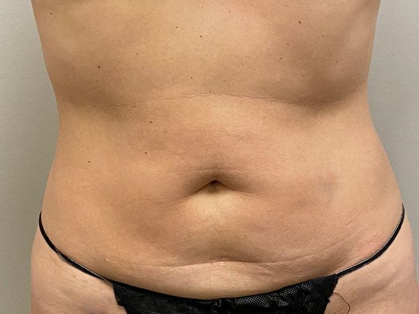 Abdominoplasty Before & After