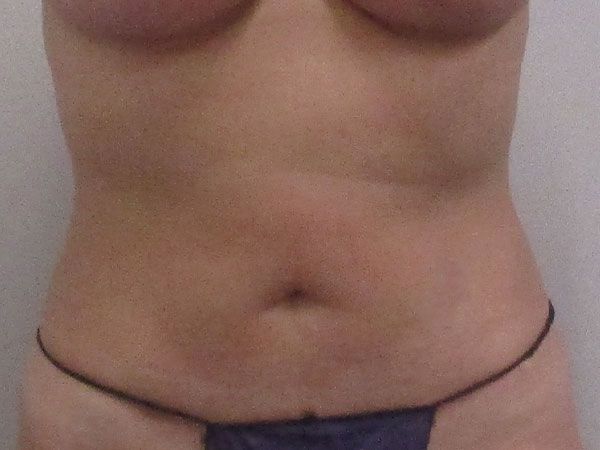 Abdominoplasty Before & After