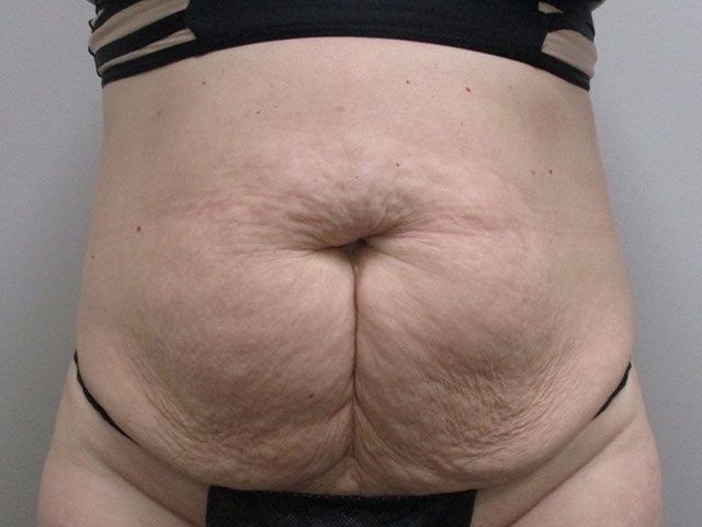 Abdominoplasty Before & After