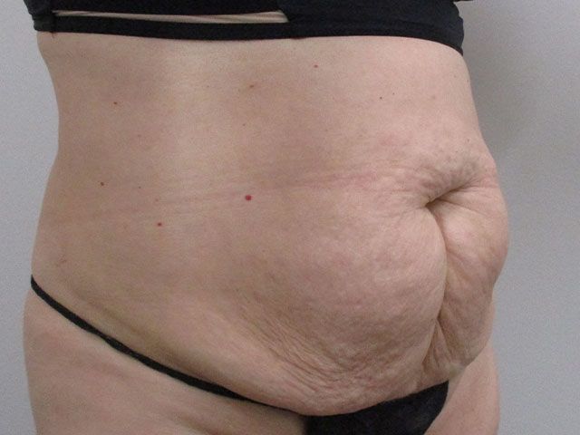 Abdominoplasty Before & After