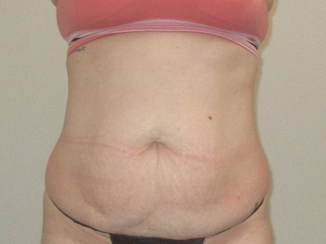 Abdominoplasty Before & After