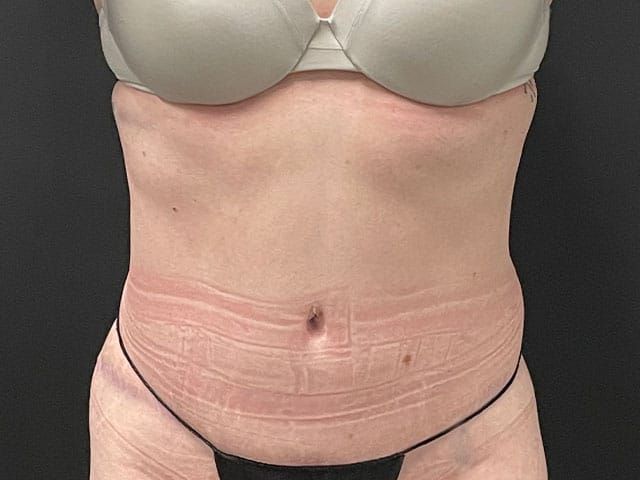 Abdominoplasty Before & After