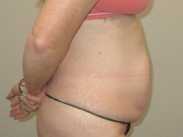 Abdominoplasty Before & After