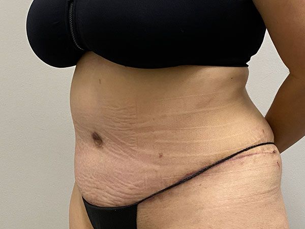 Abdominoplasty Before & After