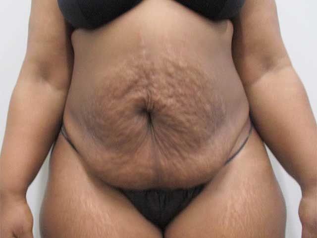 Abdominoplasty Before & After