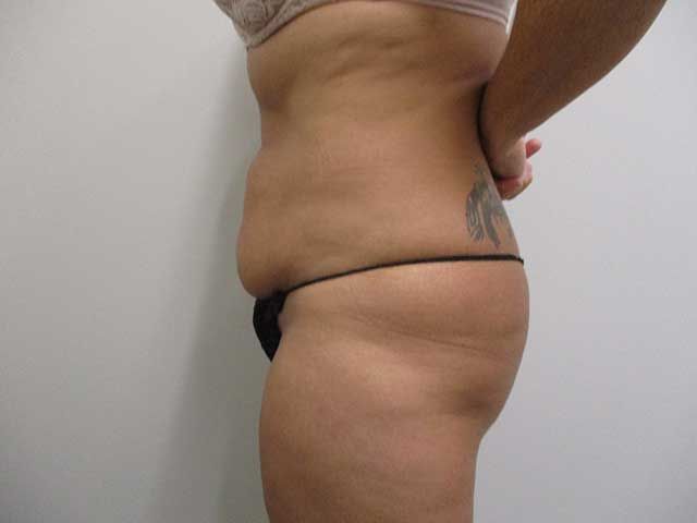 Abdominoplasty Before & After