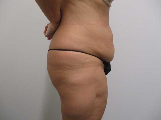 Abdominoplasty Before & After