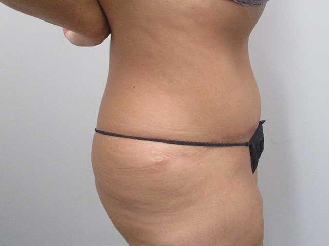 Abdominoplasty Before & After