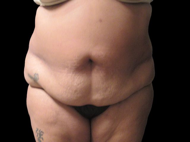 Abdominoplasty Before & After