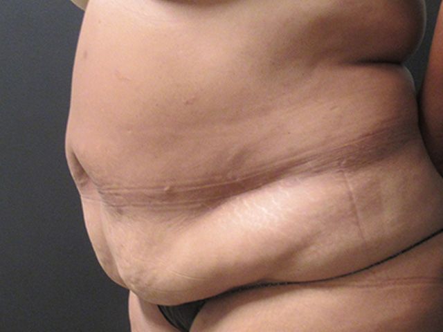 Abdominoplasty Before & After