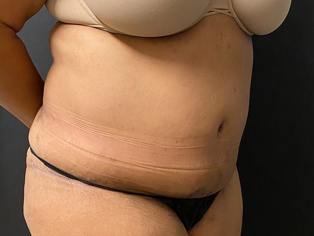 Abdominoplasty Before & After
