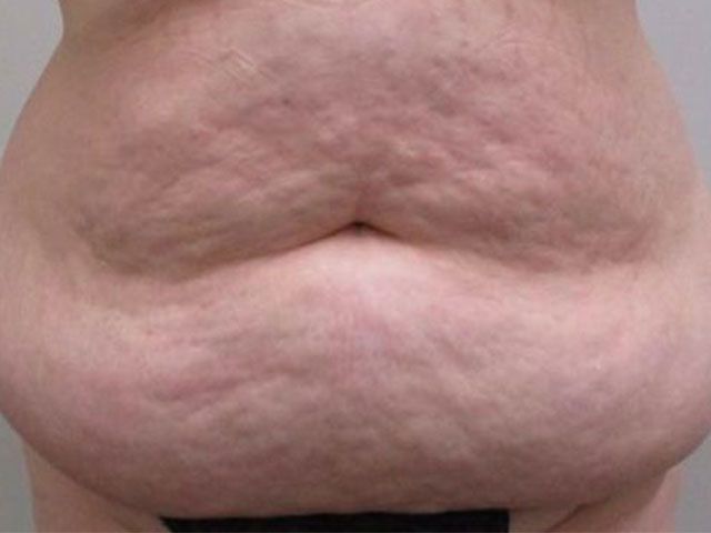 Abdominoplasty Before & After