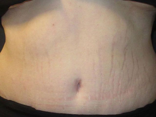 Abdominoplasty Before & After