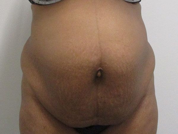 Abdominoplasty Before & After