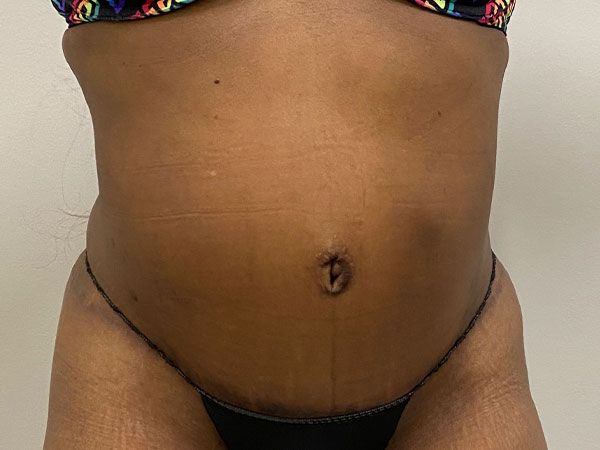 Abdominoplasty Before & After