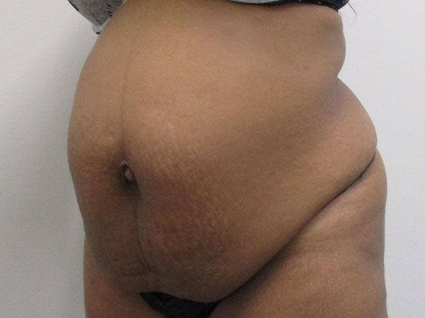 Abdominoplasty Before & After