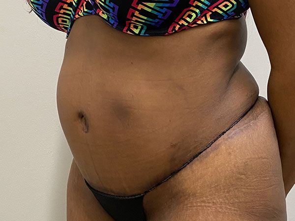 Abdominoplasty Before & After