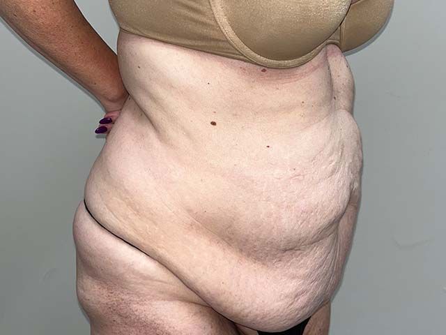 Abdominoplasty Before & After