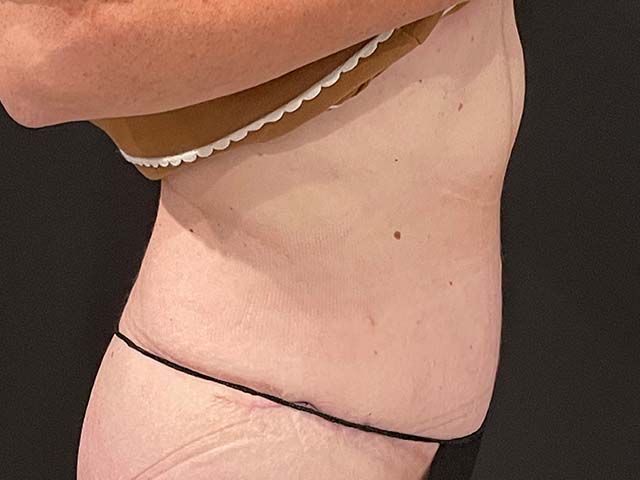 Abdominoplasty Before & After